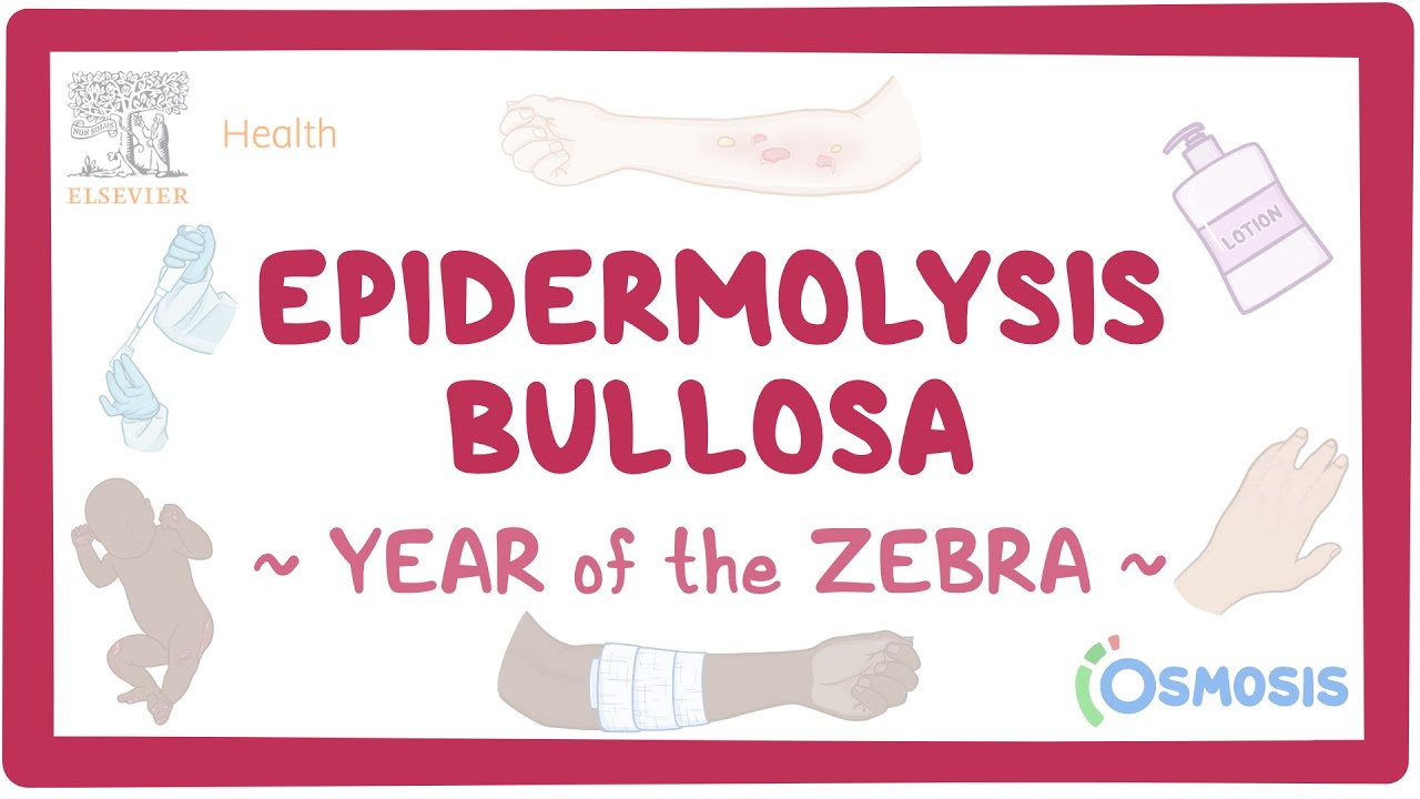 Epidermolysis Bullosa (Year of the Zebra)