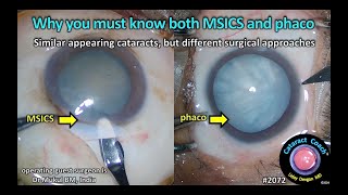 CataractCoach™ 2072: why you must know both MSICS and phaco