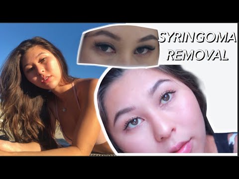 everything to know about syringoma aka my confidence destroyer
