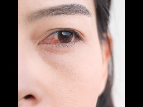 Conjunctivita, cea mai comună infecţie oculară - cauze, simptome, tratament