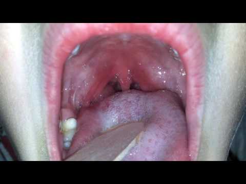 Дифтерия - причины, симптомы и лечение