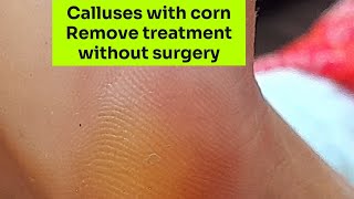 Calluses with corn Remove treatment without surgery#footcare#satisfying#wartremoval#pedicure #nails