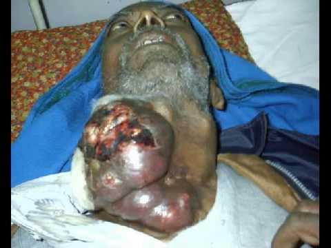 Indian Oral Cancer By Prof. Chintamani