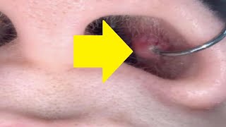 how to get rid of a piercing bump inside your nose fast and easy How To Get Rid Of Nose Piercing Bump Inside Your Nose Tutorial