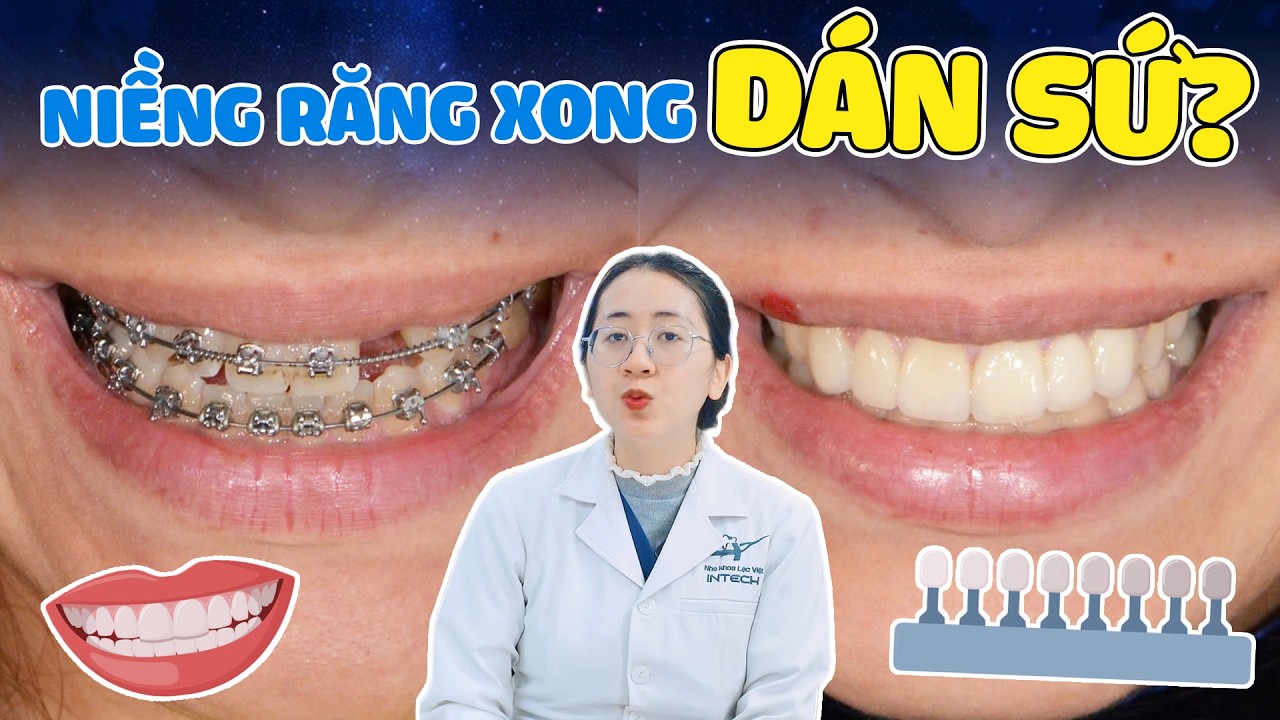 Niềng Răng Xong Dán Sứ Được Không? 70% Mọi Người Đang Hiểu Sai!