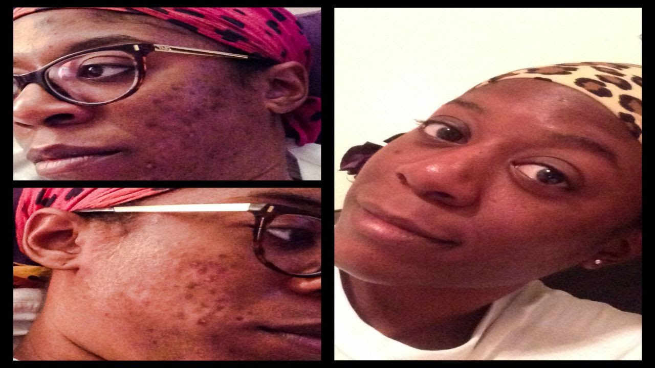 Clear Acne Using African Black Soap Fade Dark Spots Using Compounding Medication