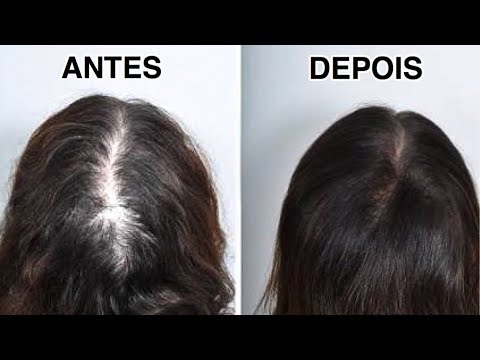 O que devo fazer quando o cabelo está caindo muito? O que pode ser? Como  acabar c/ a queda capilar? 