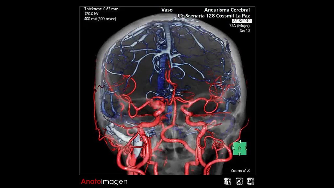 Angiotomografía Cerebral Reconstrucción Con Software De Sustracción