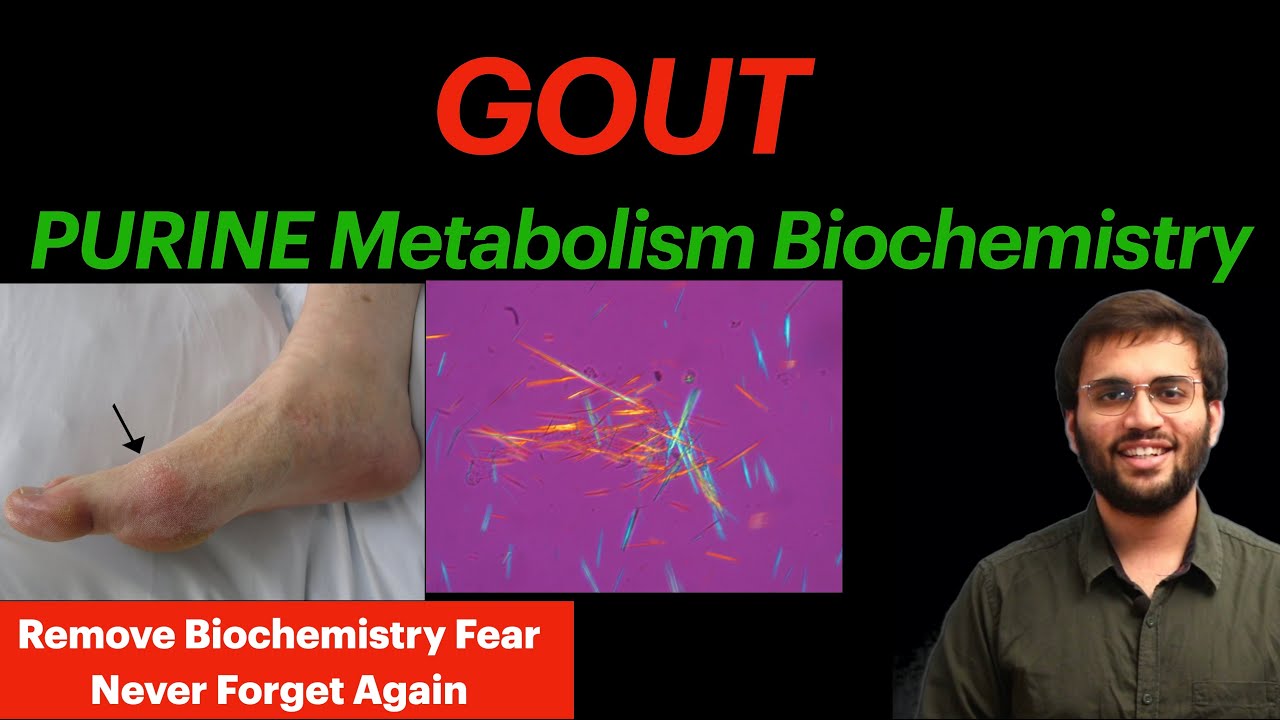 Gout | Causes, Symptoms, Diagnosis, Treatment