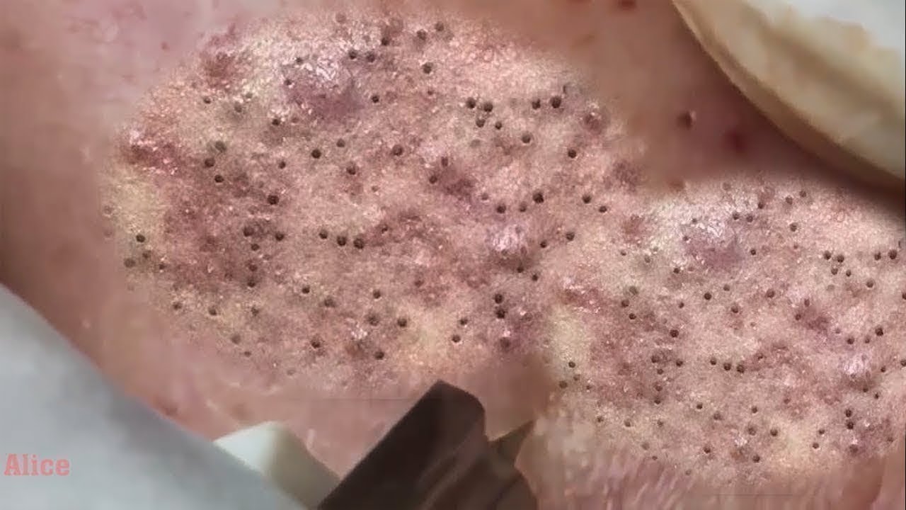 Давить Кистозные Угри Видео Новое 2022 Года Давить Кистозные Угри Видео Новое 2022 Года
