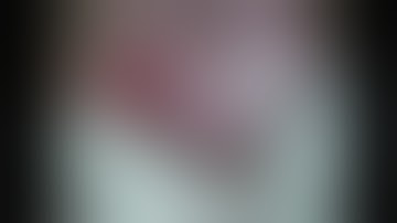 RIGID PMMA PCIOL RESCUE FROM VITREOUS CAVITY - APPROACH WHEN NO VR SETUP - Dr Saurav Piya