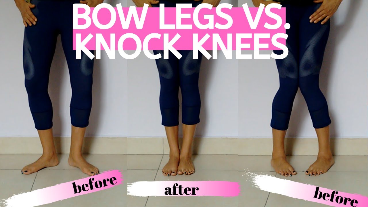 How To Correct Bow Legs In Adults - Bow Legs vs. Knock Knees