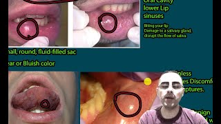 Bump in the mouth: Mucocele, Submucosal Cysts, signs, symptoms and treatment