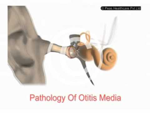 Otitis Media Hindi Youtube