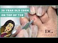 30 year old corn on top of toe