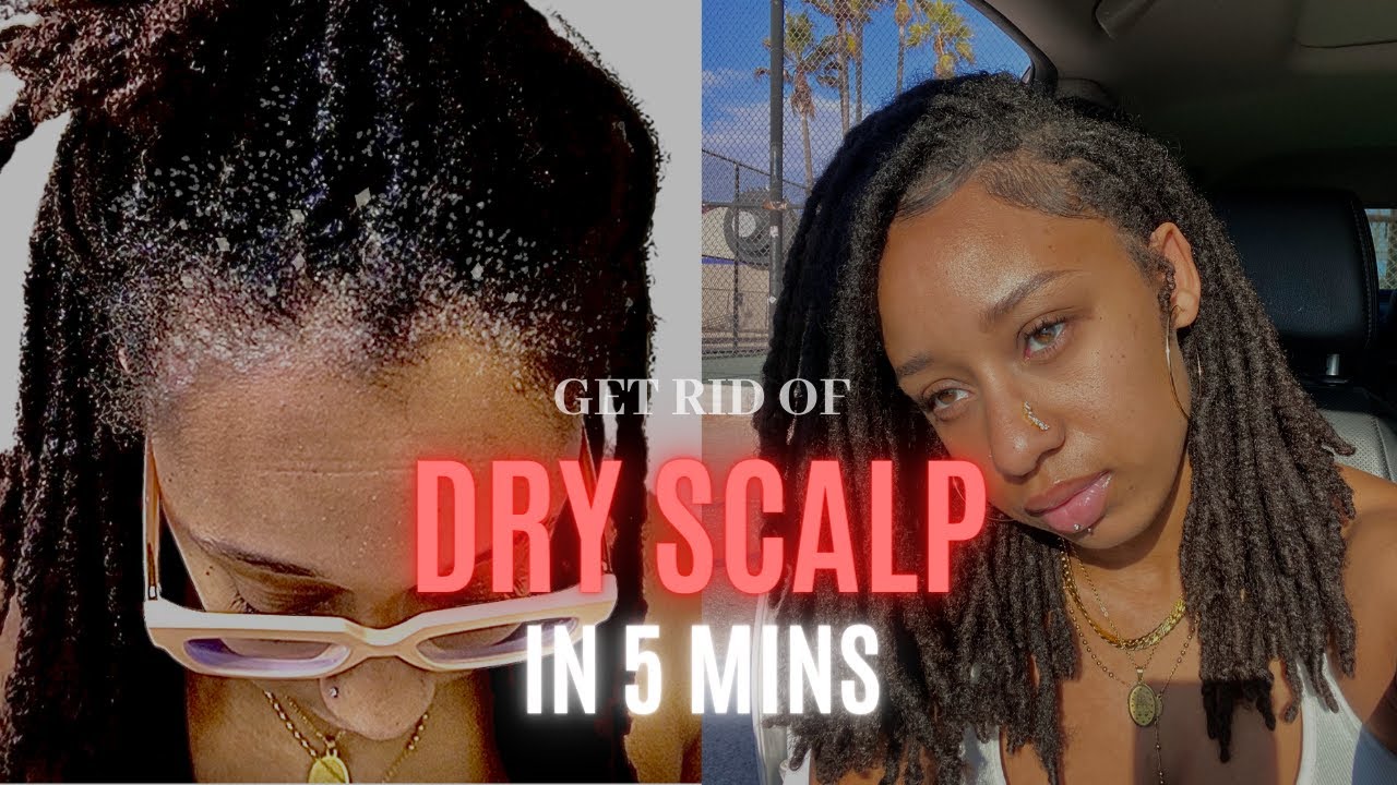 Get rid of extreme dry scalp fast: Loc Edition - YouTube