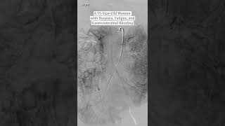Case Record of the MGH: A 55-Year-Old Woman with Dyspnea, Fatigue, and Gastrointestinal Bleeding