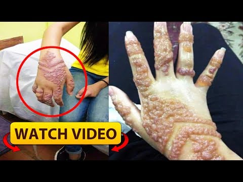 black henna tattoos can cause severe skin reactions case shows black henna tattoos can cause severe skin reactions case shows