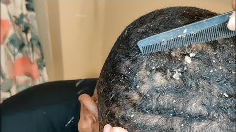 Big Flakes Return?! | Morning Dandruff Scratching