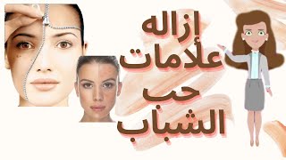 طرق إزالة أثار حب الشباب بأفضل المنتجات