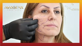 MAX FAX FACELIFT by Dr. Maen Al Khateeb- عملية شد الوجه مع د. معن الخطيب