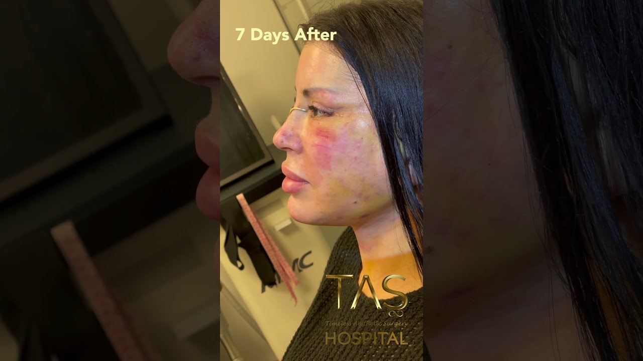Complete Facial Transformation Scarless Facelift Necklift Rhinoplasty By DR Tas