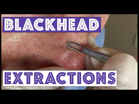 Blackheads Extracted After Mohs Surgery