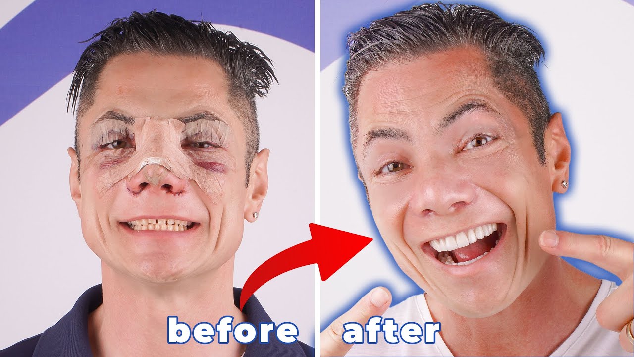 HOLLYWOOD SMILE DESIGN IN TURKEY ! - Mr. Hus - Alfa Dental Center