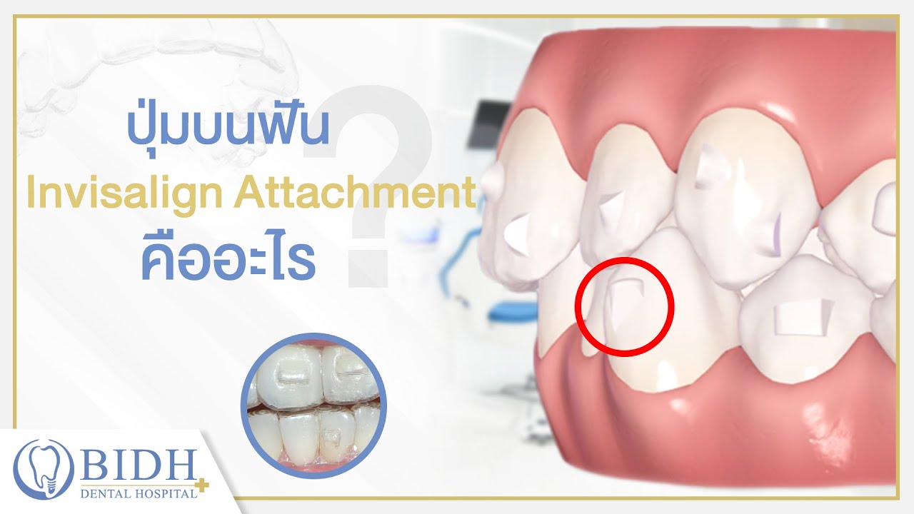 attachment คือ  New 2022  ปุ่มบนฟัน Invisalign  Attachment  คืออะไร EP.4 l โรงพยาบาลฟัน BIDH