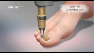 ClearChoice, a dual laser approach to onychomycosis from Alma Lasers.