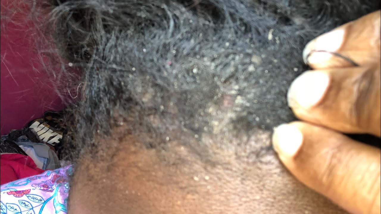 Extreme Dandruff Scratching ASMR Huge Flakes Scalp Check YouTube