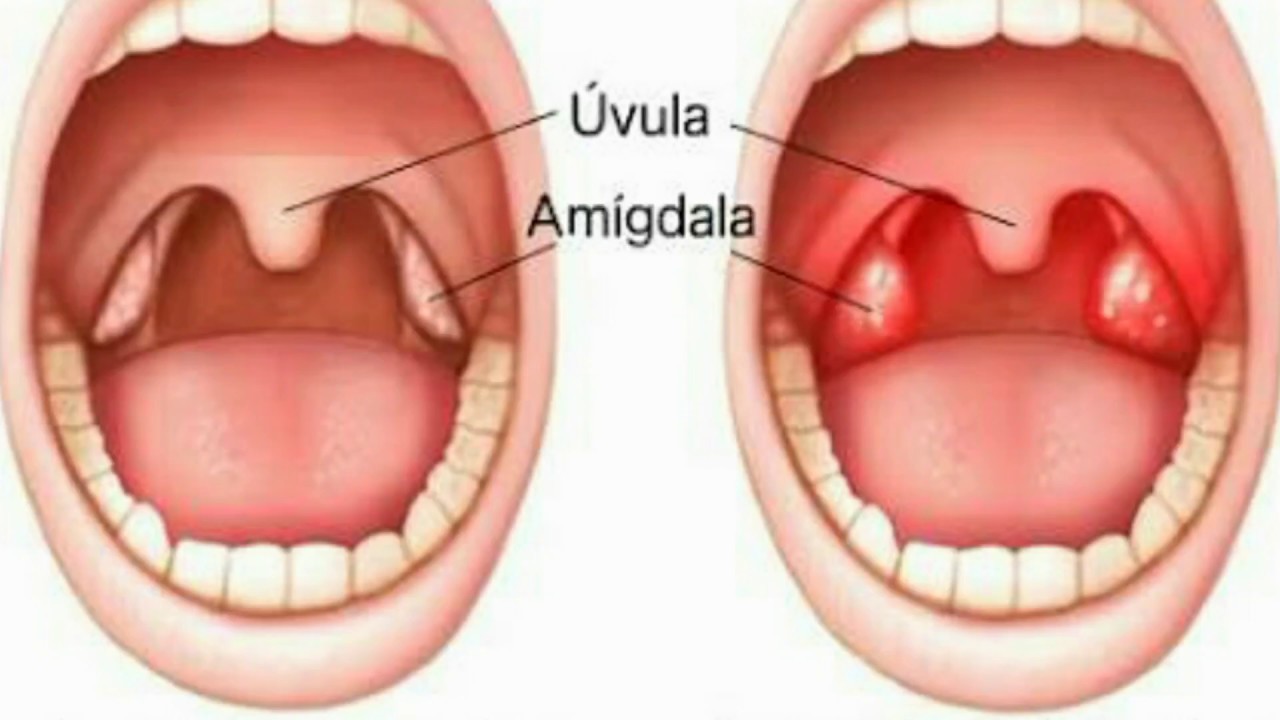 Que hacer cuando te duelen las amigdalitis