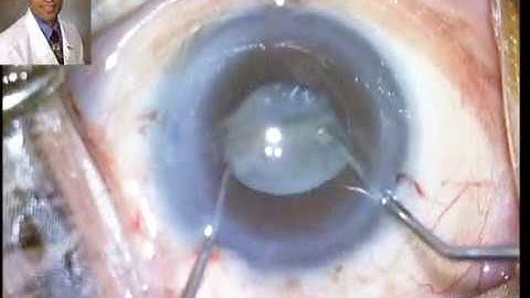 IOL Scaffold Technique for Phaco in Hypermature Calcified Cataract Dr Suresh Pandey Kota India