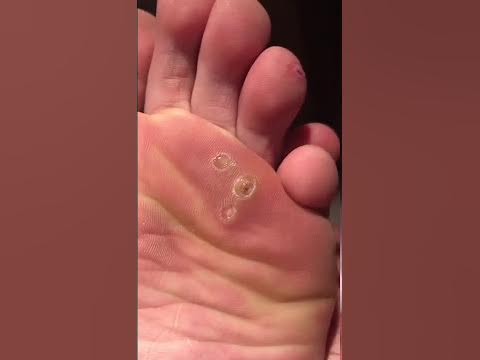 DAY 60: Plantar Wart Removal Using Compound W Update! 