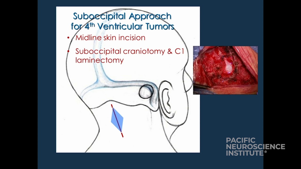Surgical Resection of Ependymoma in the 4th Ventricle