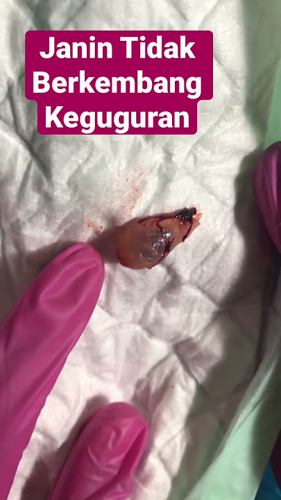 Hamil Muda Janin Tidak Berkembang Keguguran