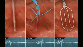 Heart Electrophysiology Machines   BMET TV