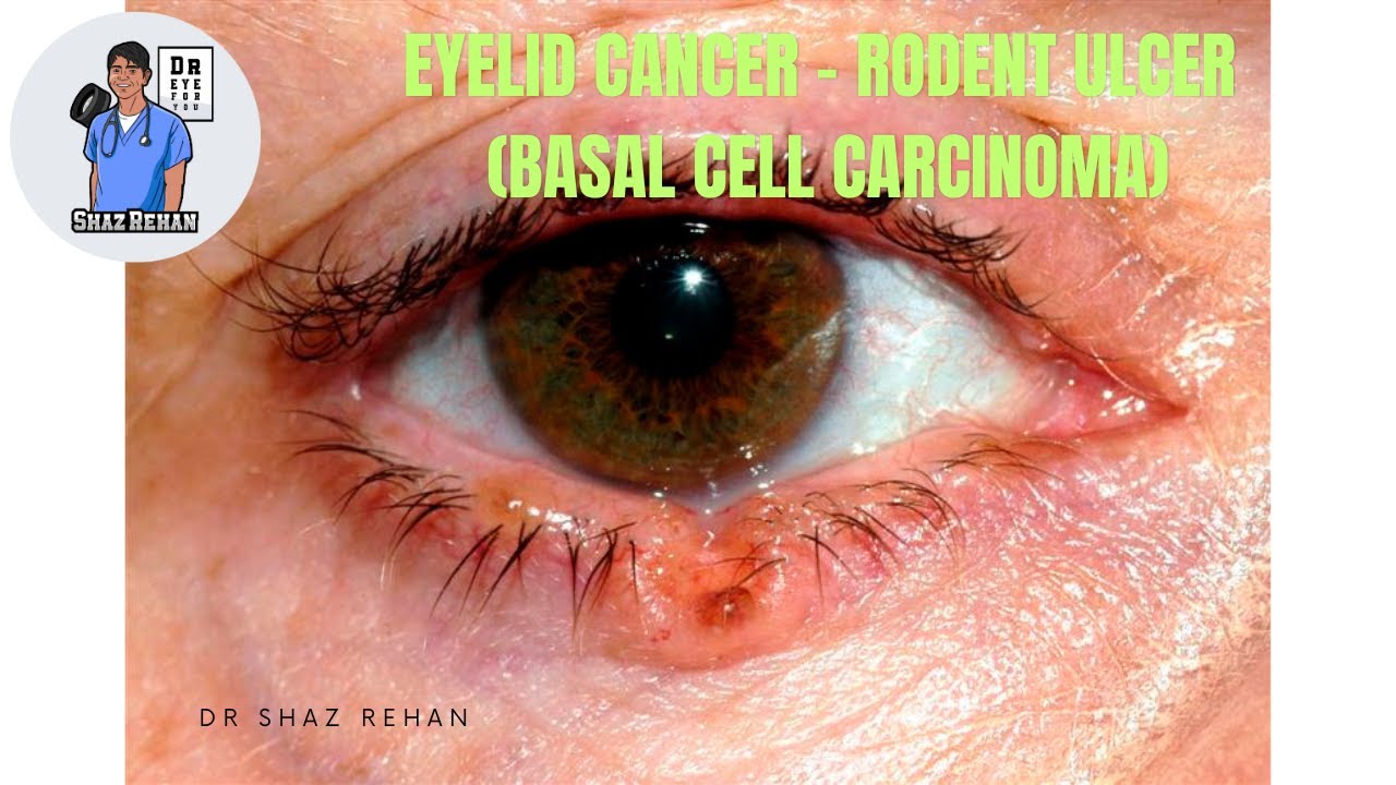 Eyelid Cancer Rodent Ulcer Eye Dr Explains YouTube Eyelid Cancer Rodent Ulcer Eye Dr Explains YouTube
