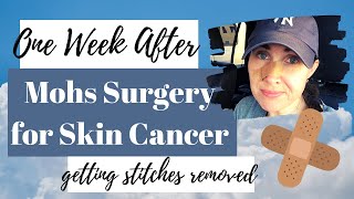 Mohs Surgery for Skin Cancer | Update One Week After Mohs Surgery to Remove My Skin Cancer