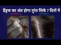 डैंड्रफ का अंत होगा तुरंत सिर्फ 7 दिनों में  Dandruff Treatment at Home in Hindi | Rusi se Chutkara