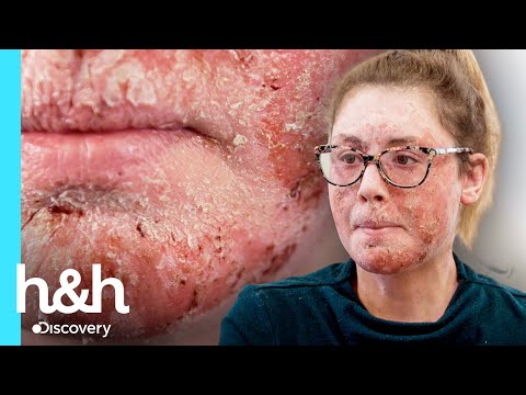 Paciente con eczema rechaza tratamiento por sus creencias | Clínica de la piel | Discovery H&H