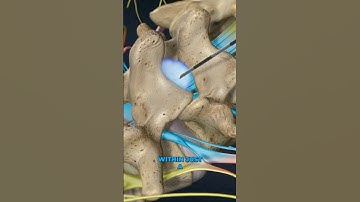 Lumbar Epidural Steroid Injection (3D Animation)