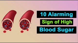 𝐏𝐚𝐫𝐭27 | 10 Alarming Signs Of High Blood Sugar