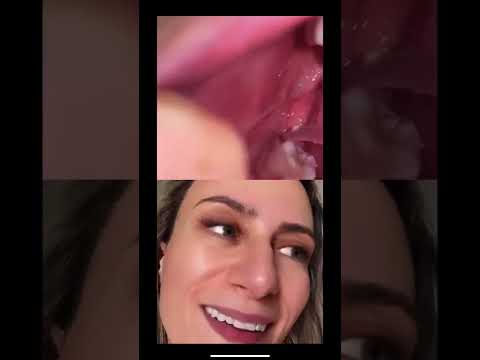 Vídeo: O buraco do dente do siso fechará com comida nele?