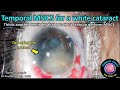 Cataractcoach 2140 temporal msics for a white cataract