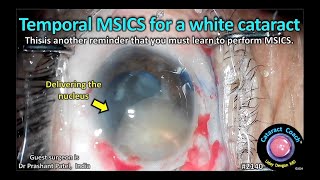 CataractCoach™ 2140: temporal MSICS for a white cataract