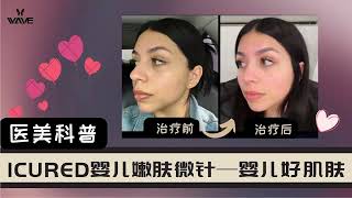 【医美科普】ICure婴儿嫩肤微针--重获婴儿好肌肤啦