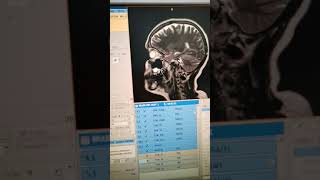 Brain MRI post contrast رنين مغناطيسي  للدماغ مع الصبغة