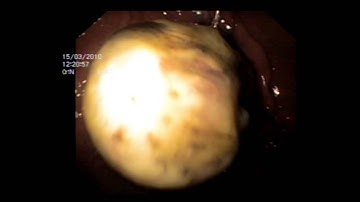 "Loop and let go" endoscopic technique for gastric GIST.