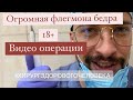 Флегмона бедра. Вскрытие. Дренирование. Дренаж. Phlegmon of the thigh. Autopsy. Drainage.